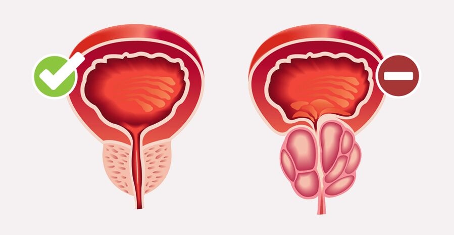 Prostamin Forte нормализует размер и функцию простаты